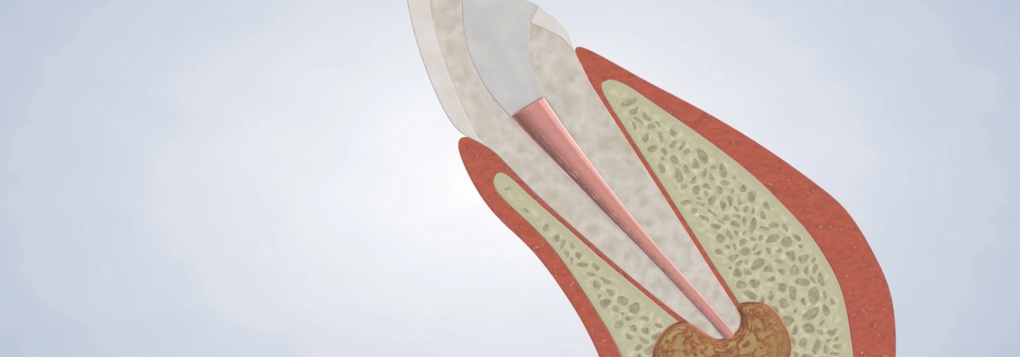 endodontic retreatment procedure desktop