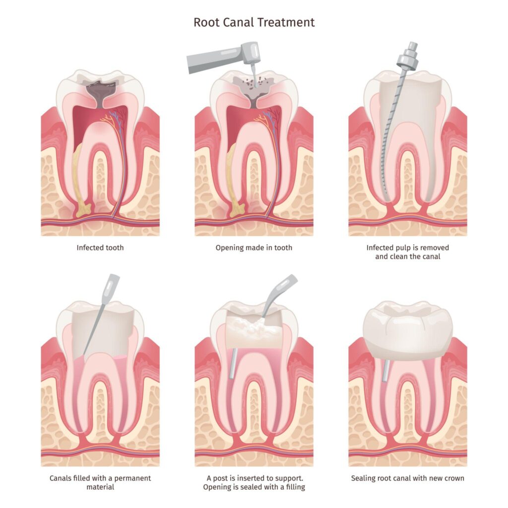 rct1